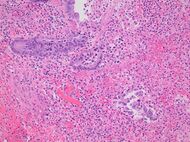 Histopathology of necrotizing appendicitis, high magnification.jpg