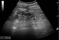 Chronic pyelonephritis with reduced kidney size and focal cortical thinning. Measurement of kidney length on the US image is illustrated by '+' and a dashed line.[44]