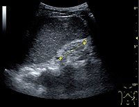 End-stage chronic kidney disease with increased echogenicity, homogenous architecture without visible differentiation between parenchyma and renal sinus and reduced kidney size. Measurement of kidney length on the US image is illustrated by '+' and a dashed line.[44]