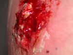 Mrsa cyst exploded.jpg