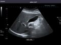 Gallbladder