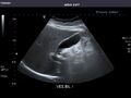 Gallbladder