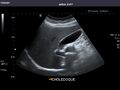 Bile duct