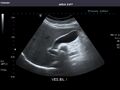 Gallbladder