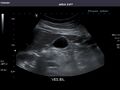 Gallbladder