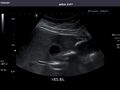 Gallbladder