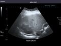 Right kidney