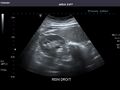 Right kidney