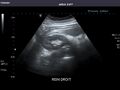 Right kidney