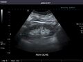 Left kidney