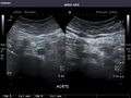 Aorta