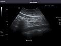 Aorta
