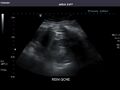 Left kidney