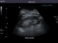 Left kidney