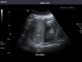Spleen