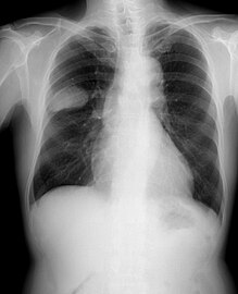 Frontal chest X-ray showing a probable S2–S3 small cell carcinoma in the right side lung.
