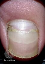 Beau lines seen in first left toenail (DermNet NZ beau-lines-2-v2).jpg