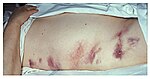 Hemorrhagic pancreatitis - Grey Turner's sign.jpg