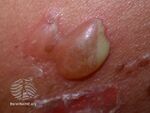 Pemphigus vulgaris (DermNet NZ pemphigus-vulgaris-20).jpg