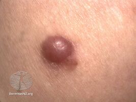 Amelanotic nodular melanoma