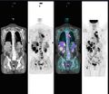 Abnormal whole body PET/CT scan with multiple metastases from a cancer. The whole body PET/CT scan has become an important tool in the evaluation of cancer.