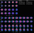 Nuclear medicine myocardial perfusion scan with thallium-201 for the rest images (bottom rows) and Tc-Sestamibi for the stress images (top rows). The nuclear medicine myocardial perfusion scan plays a pivotal role in the non-invasive evaluation of coronary artery disease. The study not only identifies patients with coronary artery disease; it also provides overall prognostic information or overall risk of adverse cardiac events for the patient.