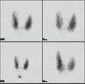 Thyroid scan with iodine-123 for evaluation of hyperthyroidism.