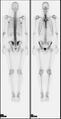 A nuclear medicine whole body bone scan. The nuclear medicine whole body bone scan is generally used in evaluations of various bone-related pathology, such as for bone pain, stress fracture, nonmalignant bone lesions, bone infections, or the spread of cancer to the bone.