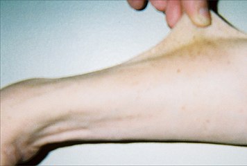 Thirty-seven-year-old patient demonstrating hyperelasticity