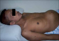 Desmoplastic small-round-cell tumor1.png