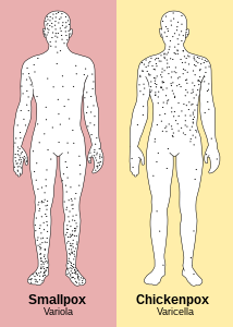 Smallpox (similar distribution to mpox) versus chickenpox