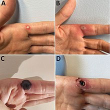 Progression of monkeypox after needlestick injury from a pustule at work[38]